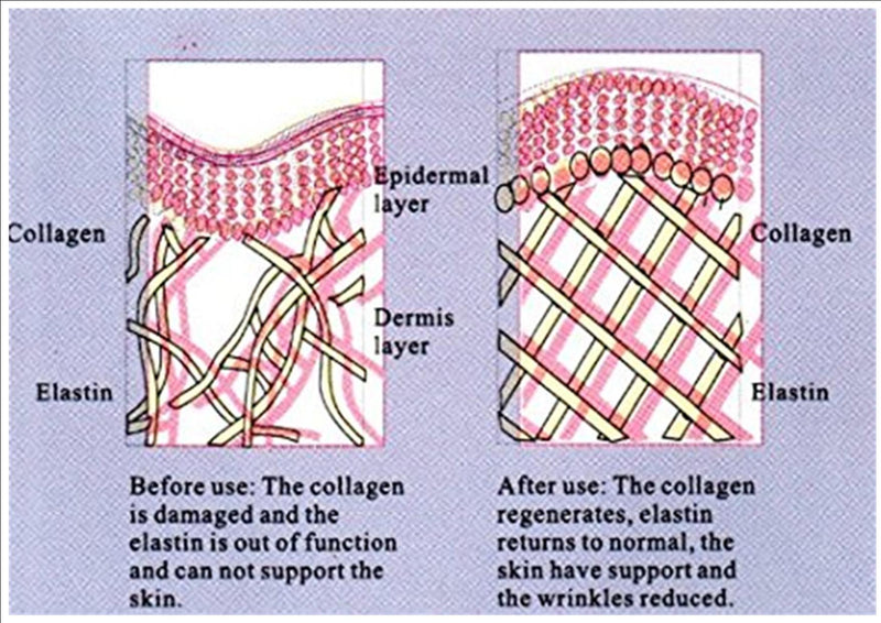 Skin Tightening